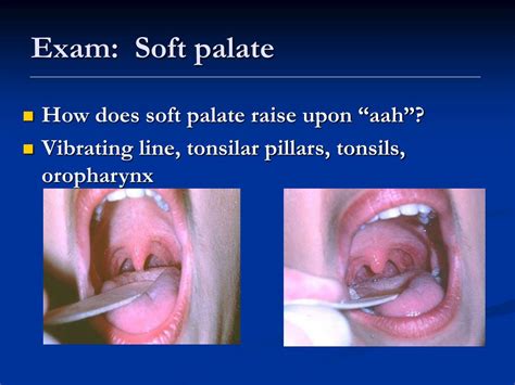 how to test rise of soft palate|palatal function test.